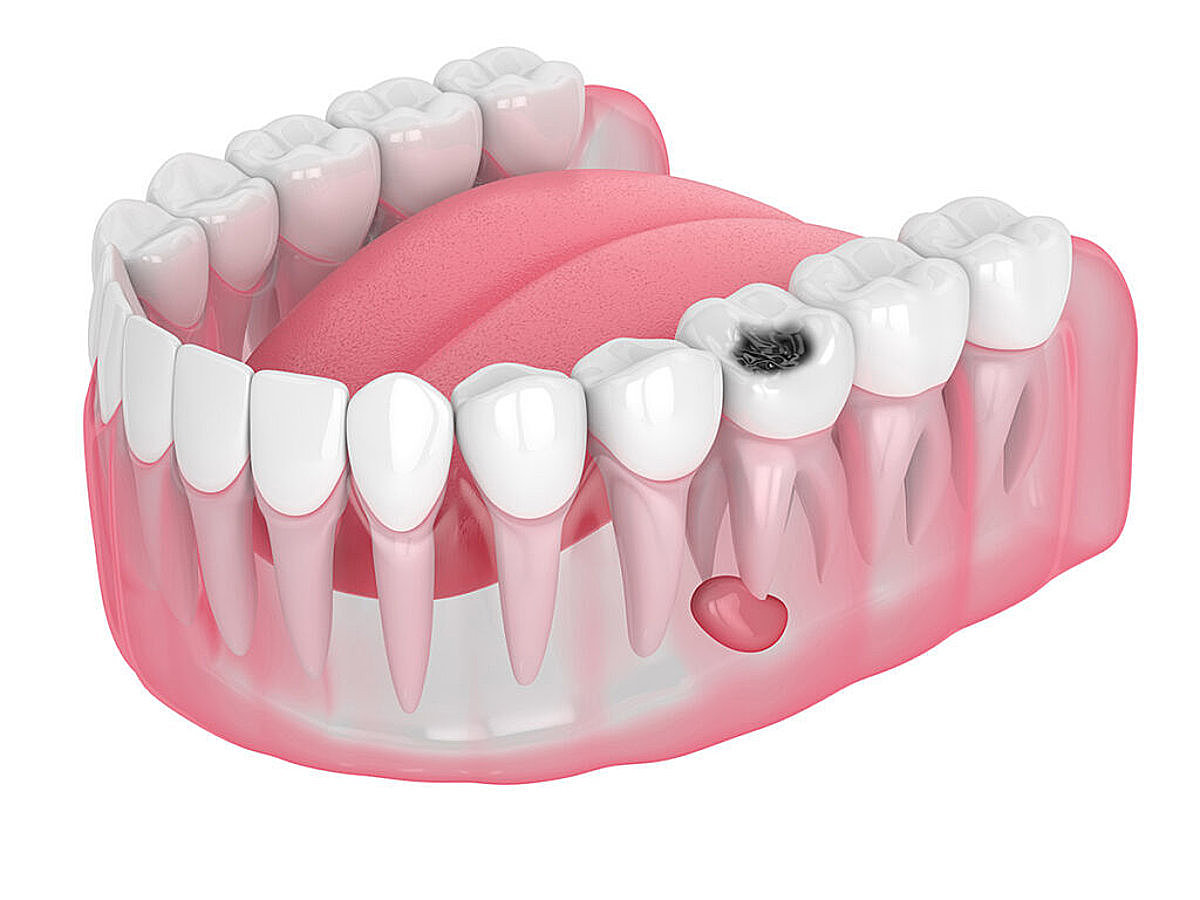 Лечение кисты зуба без удаления зуба